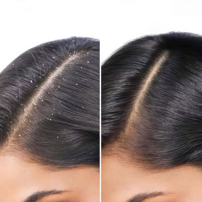 shampoo for itchy scalp - anti dandruff shampoo