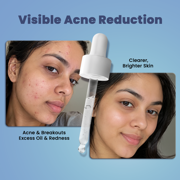 Vedscience Oil Control Serum - 30 ml